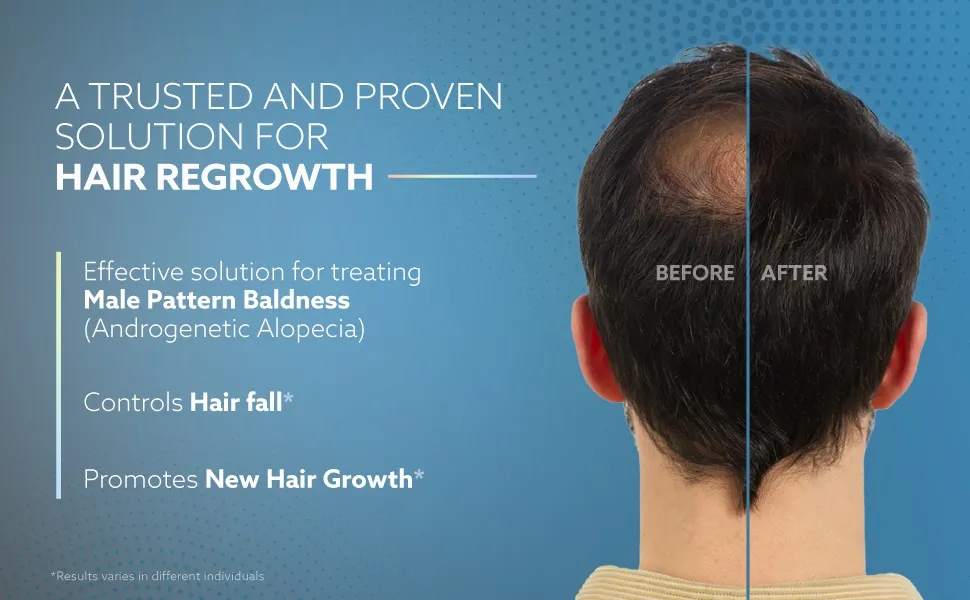 Dr. Reddy's Minoxidil Topical Solution USP 2% Mintop Forte Hair Restore Formula - Image 6